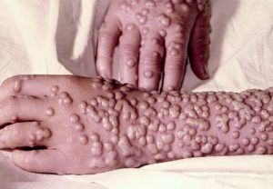 Penyakit cacar (smallpox) menurun secara drastik sejak kempen vaksinisasi seluruh dunia.