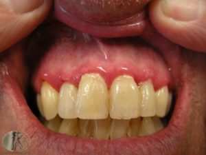 Dengan periodontium apakah yang dimaksudkan penyakit Periodontitis